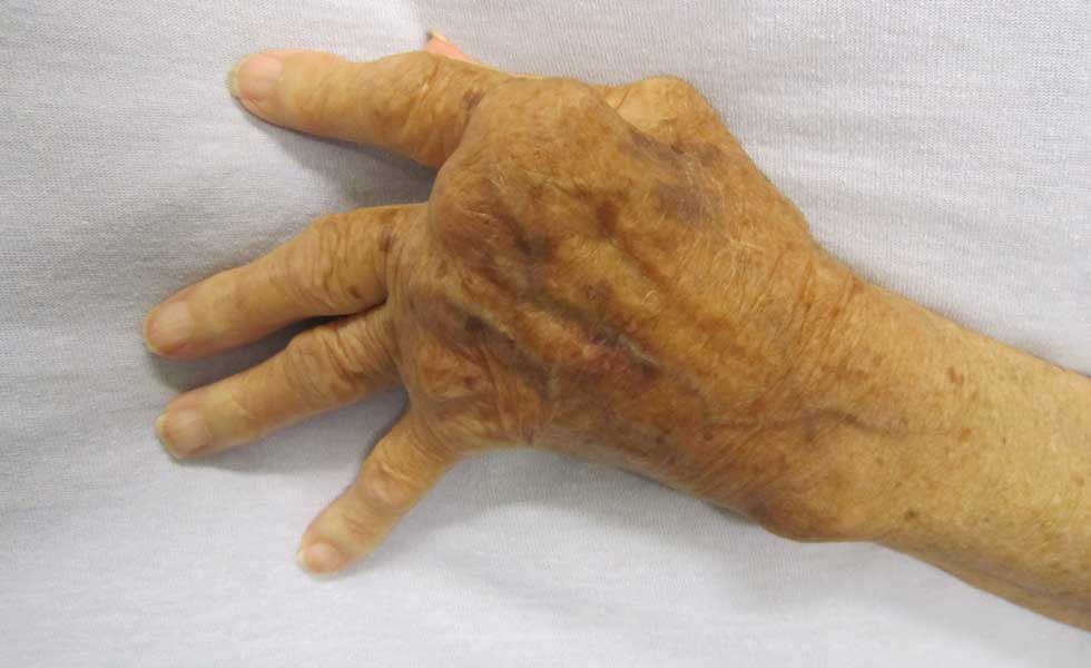 30164736Mano-Artritis-Reumatoide-Gsdu