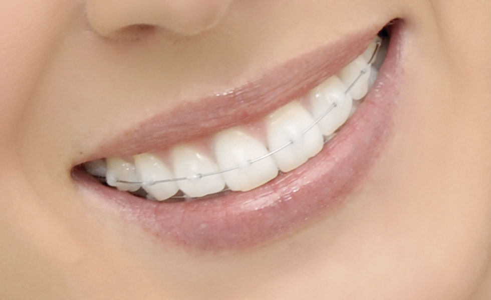 Ortodoncia-Dientes-Sonrisa