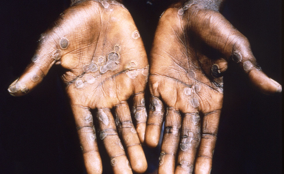 Efectos de la viruela en el cuerpo humano
Foto: EFE